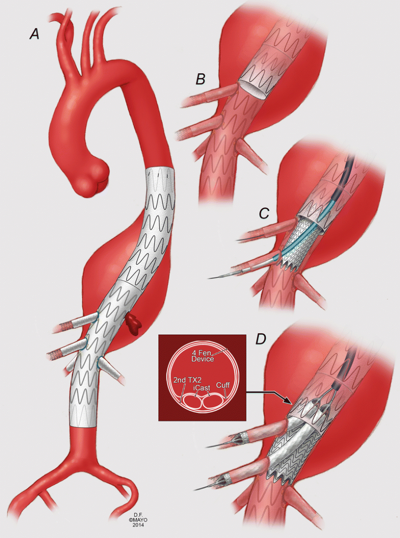 Parallel Graft Techniques to Treat Complex Aortic Aneurysms Involving ...