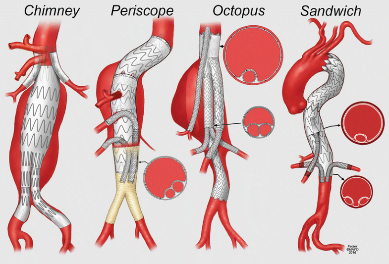 Classification Systems Relevant to Complex Endovascular Aortic Repair