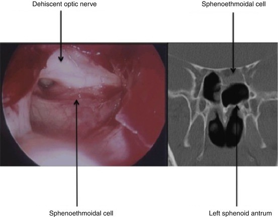 Surgery For Sphenoid Sinus Disease Springerlink