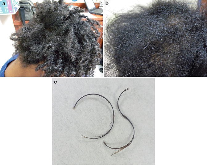 Clinical Signs Of Hair Damage Springerlink