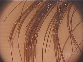 Clinical Signs Of Hair Damage Springerlink