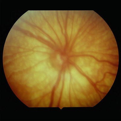 Oculofacial Manifestations Of Chromosomal Aberrations Springerlink