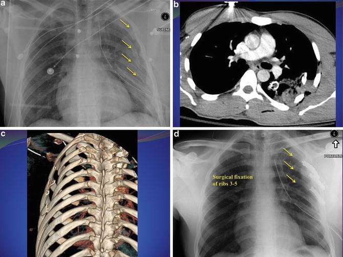 Introduction, Epidemiology, and Definition of Chest Wall Injuries