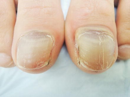 Subungual Hematoma Springerlink