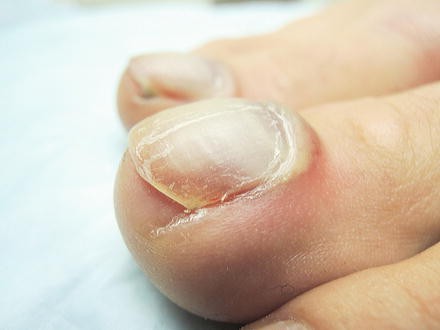 Subungual Hematoma Springerlink