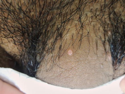 virusul hpv cele 4 grupe de sange