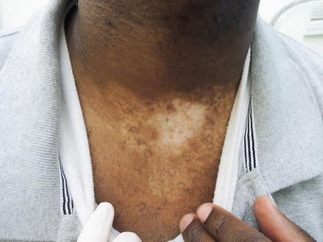 Penis the vitiligo of Vitiligo on