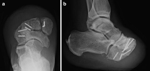 Transmetatarsal and Lisfranc Amputation | SpringerLink