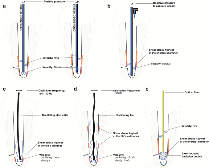 The Role of Irrigation in Endodontics SpringerLink