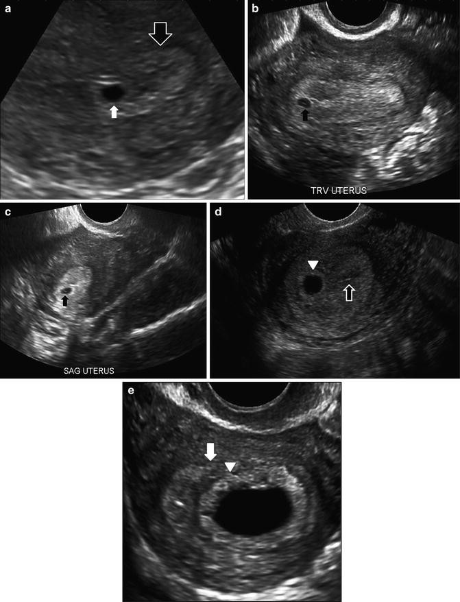Normal First Trimester Of Pregnancy Springerlink