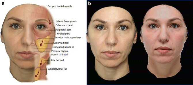 mentolabial sulcus filler