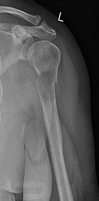 closed fracture of proximal end of right humerus closed fracture of proximal end of right humerus