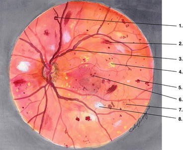 Nonproliferative Diabetic Retinopathy Springerlink