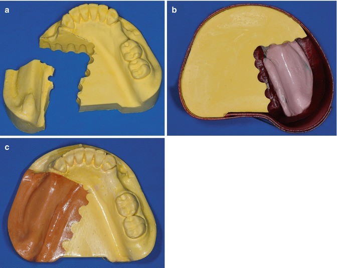impressions for removable partial dentures springerlink altered cast technique