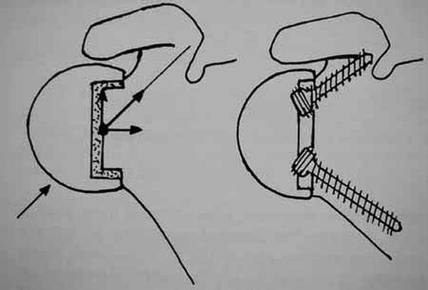 Fh Orthopedics Arrow Universal Shoulder Prosthesis Springerlink