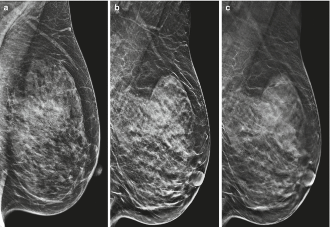 Lorad mammography equipment picture