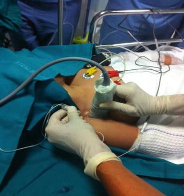 Body Cast Catheter Body Cast Catheter