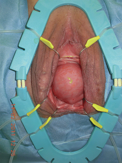Comorbidities Associated With Vaginal Hysterectomy Springerlink