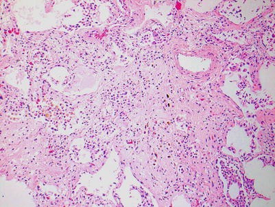 Lung Transplant Pathology Springerlink - 