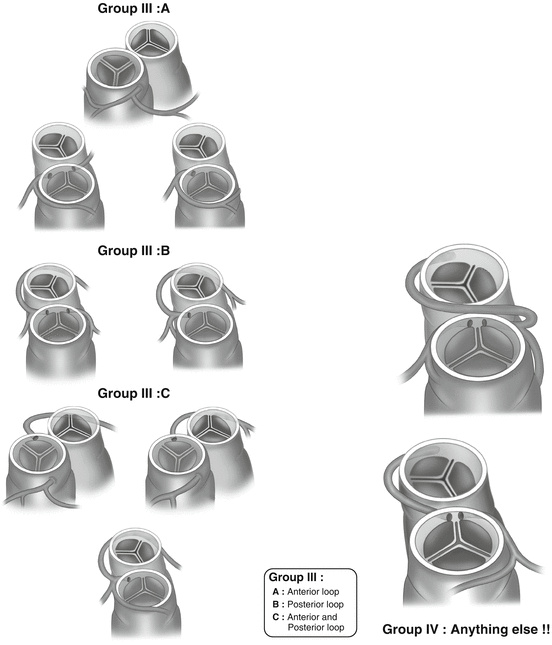 Anatomy of Conotruncal Anomalies | SpringerLink
