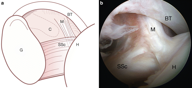 Retracted Subscapularis Tears | SpringerLink