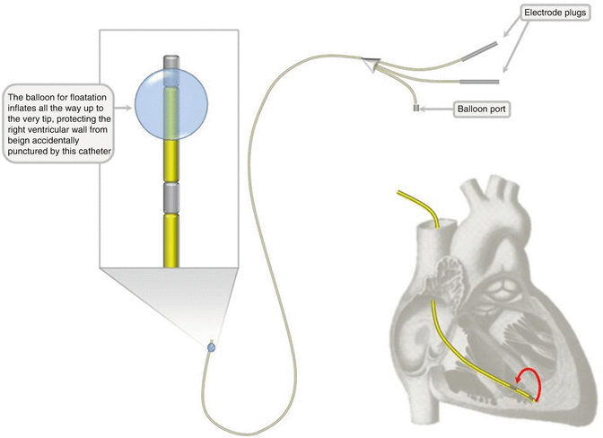 Temporary Transvenous Pacemakers | SpringerLink