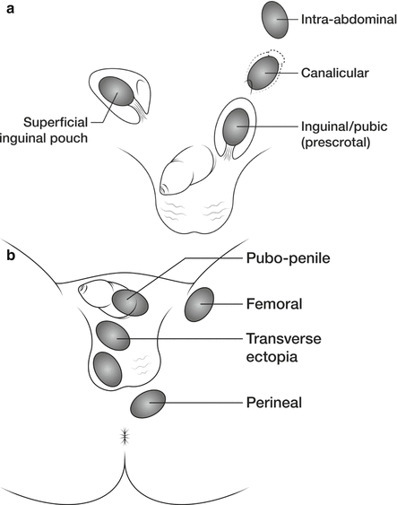 retentio testis vuxen