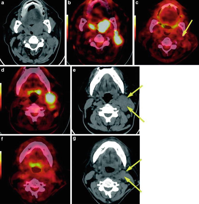 Diagnostic Applications Of Nuclear Medicine Head And Neck - 