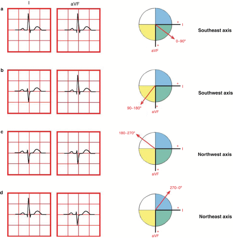 Cardiac Axis Calculation and Interpretation SpringerLink