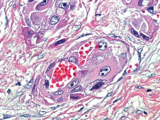 Fibrolamellar Hepatocellular Carcinoma Springerlink Fibrolamellar Hepatocellular Carcinoma Springerlink