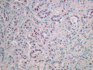 Hilar Perihilar Cholangiocarcinoma Klatskin Tumor Springerlink Images, Photos, Reviews