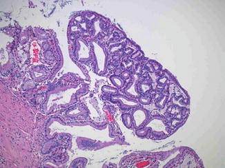 Villous papilloma gallbladder Papilloma in gallbladder