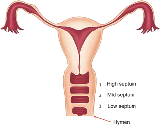 All About Endometrial Uterine Cancer Oncolink