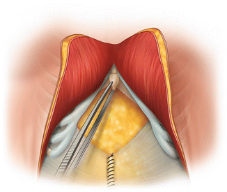 Rives-Stoppa Retromuscular Repair | SpringerLink