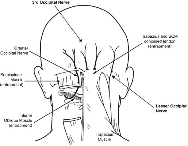 Greater Occipital Nerve Entrapment | SpringerLink
