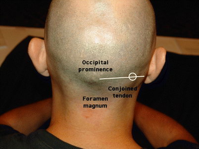 Lesser Occipital Nerve Entrapment | SpringerLink