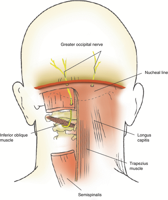 Suboccipital Neuralgia and Decompression | SpringerLink