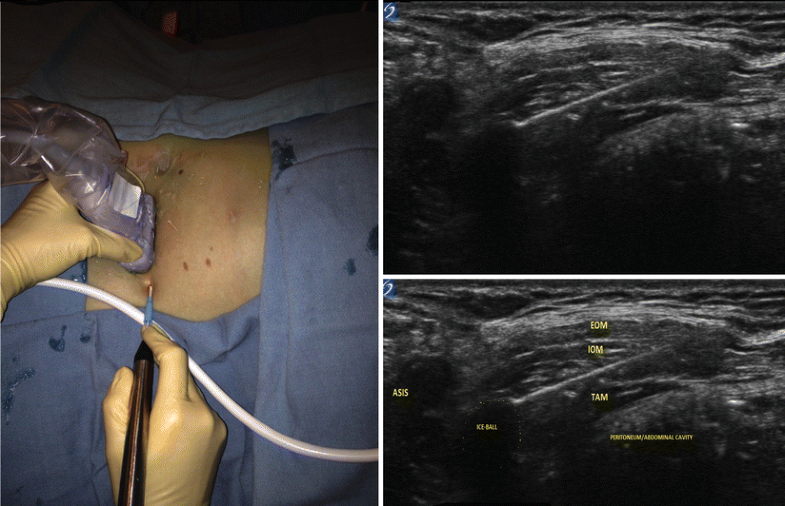 Ilioinguinal Nerve Entrapment: Pelvic | SpringerLink