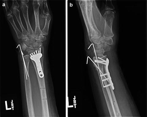 Distal Radius Fractures with Ulnar Head and Neck Fractures ...