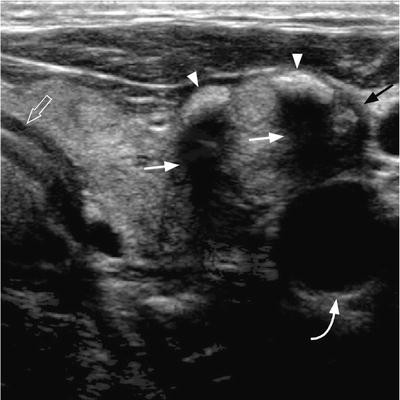 Ultrasound Investigations In Head And Neck Cancer Patients Springerlink