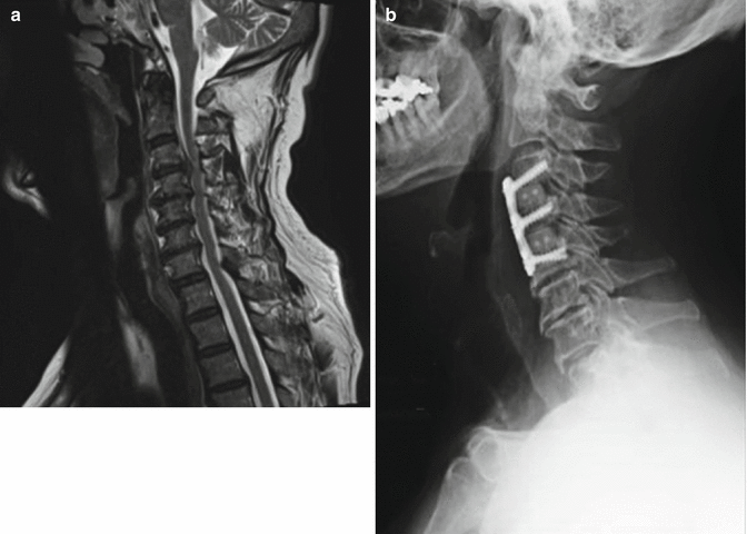Anterior Cervical and Arthrodesis