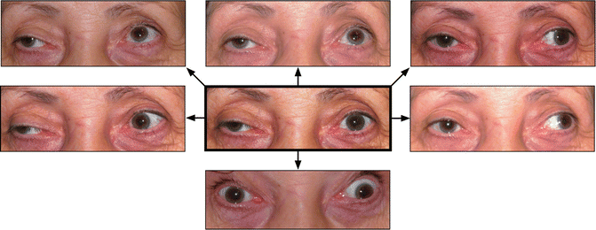 The Most Important Clinical Syndromes of Acquired Nuclear and ...