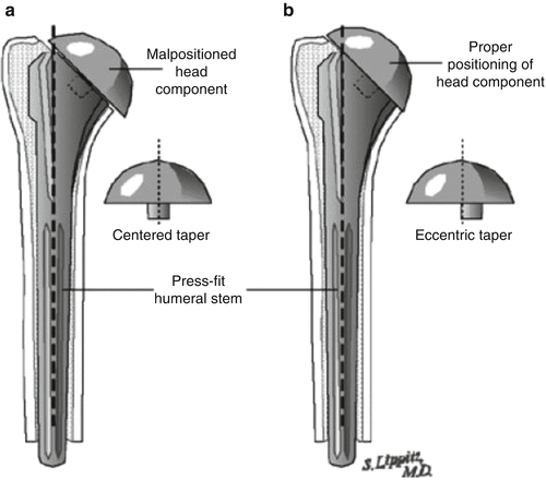Humeral Head Replacement: Anatomy and Biomechanics | SpringerLink