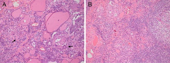 Acute And Subacute Thyroiditis Springerlink