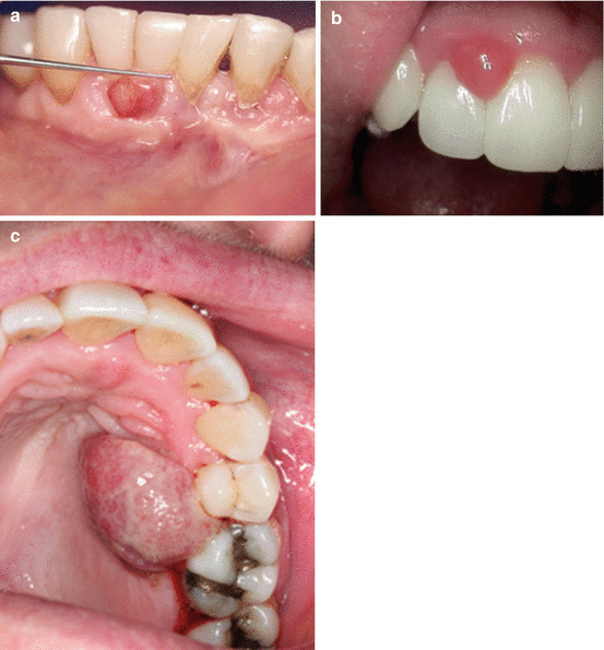 Common Lesions in Oral Pathology for the General Dentist SpringerLink