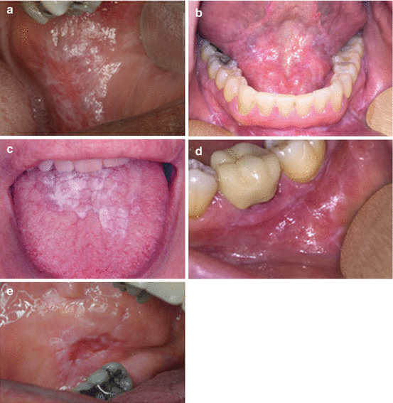 Common Lesions in Oral Pathology for the General Dentist SpringerLink