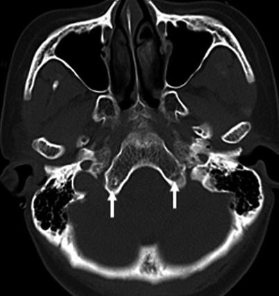 Pediatric Skull: Normal Pediatric Sutures on Computed Tomography ...