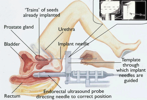 Correct Prostate Massage Correct Prostate Massage