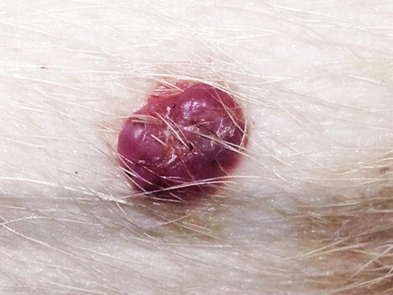 Cutaneous Metastasis From Non Primary Skin Tumors Springerlink