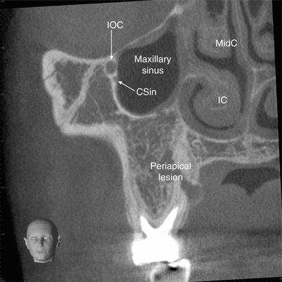 maxillary sinus springerlink maxillary sinus
